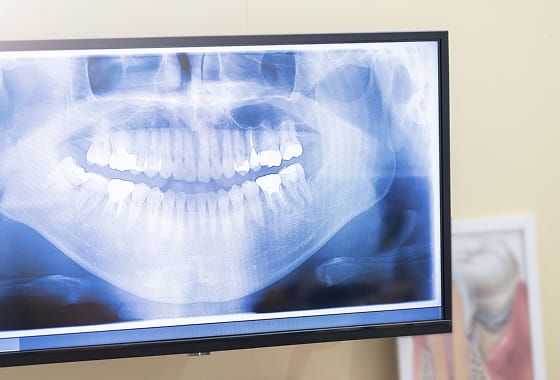 歯のレントゲン写真
