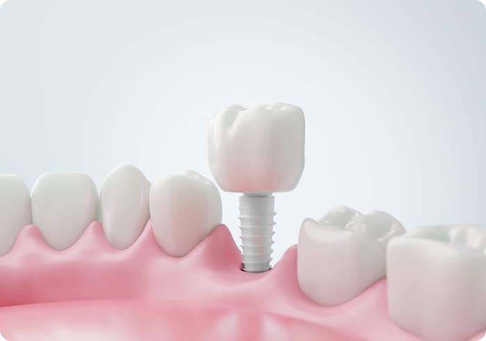 インプラントの説明図